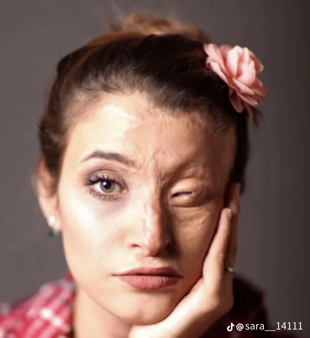 Survivante des attaques à l’acide d’Ispahan, portrait — un œil intact, une moitié du visage marquée par la brûlure, une fleur rose dans les cheveux.